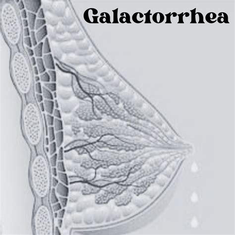 is galactorrhea safe to drink|Galactorrhea: What It Is, Causes, Symptoms, and。